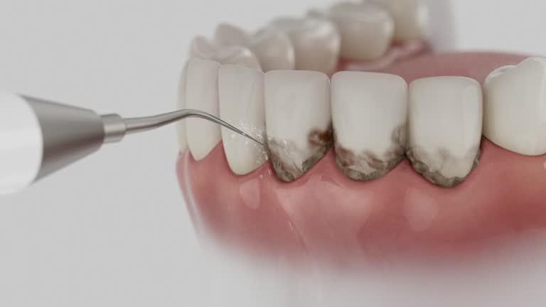 Trusted Wisdom Tooth Removal service in Stallion Springs, CA - Dentist Open Now